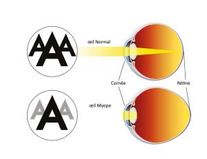 Schéma d'un oeil sans myopie et d'un oeil avec myopie